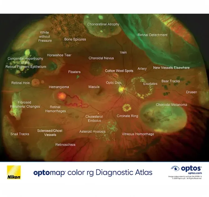 Optomap ultra-widefield retinal image