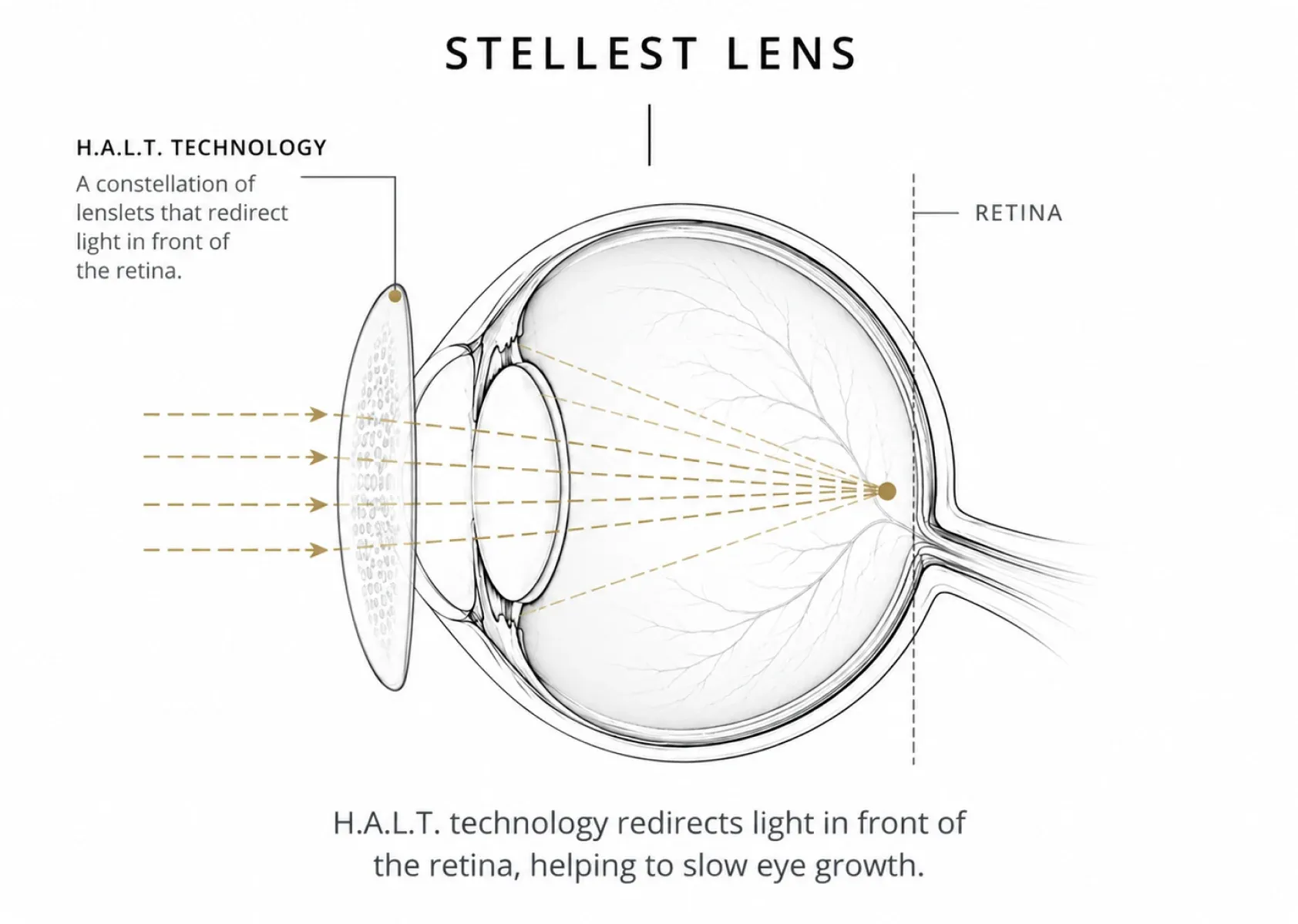 Child being fitted with Stellest lenses