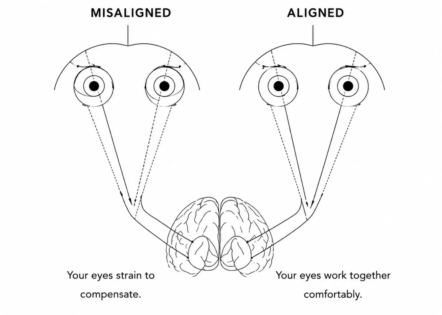 Diagram comparing misaligned and aligned eyes