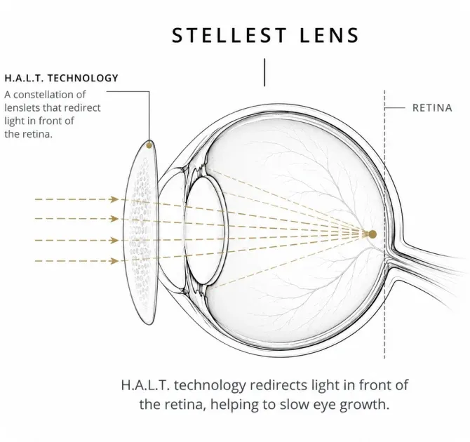 Child being fitted with Stellest lenses