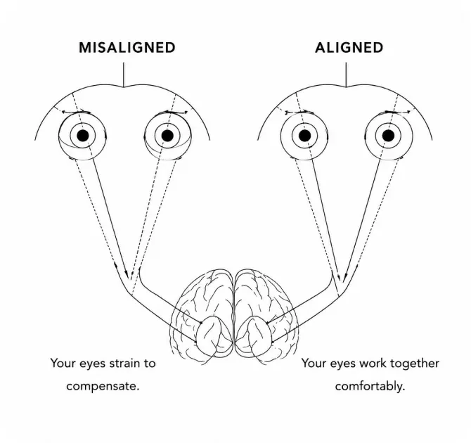 Diagram comparing misaligned and aligned eyes
