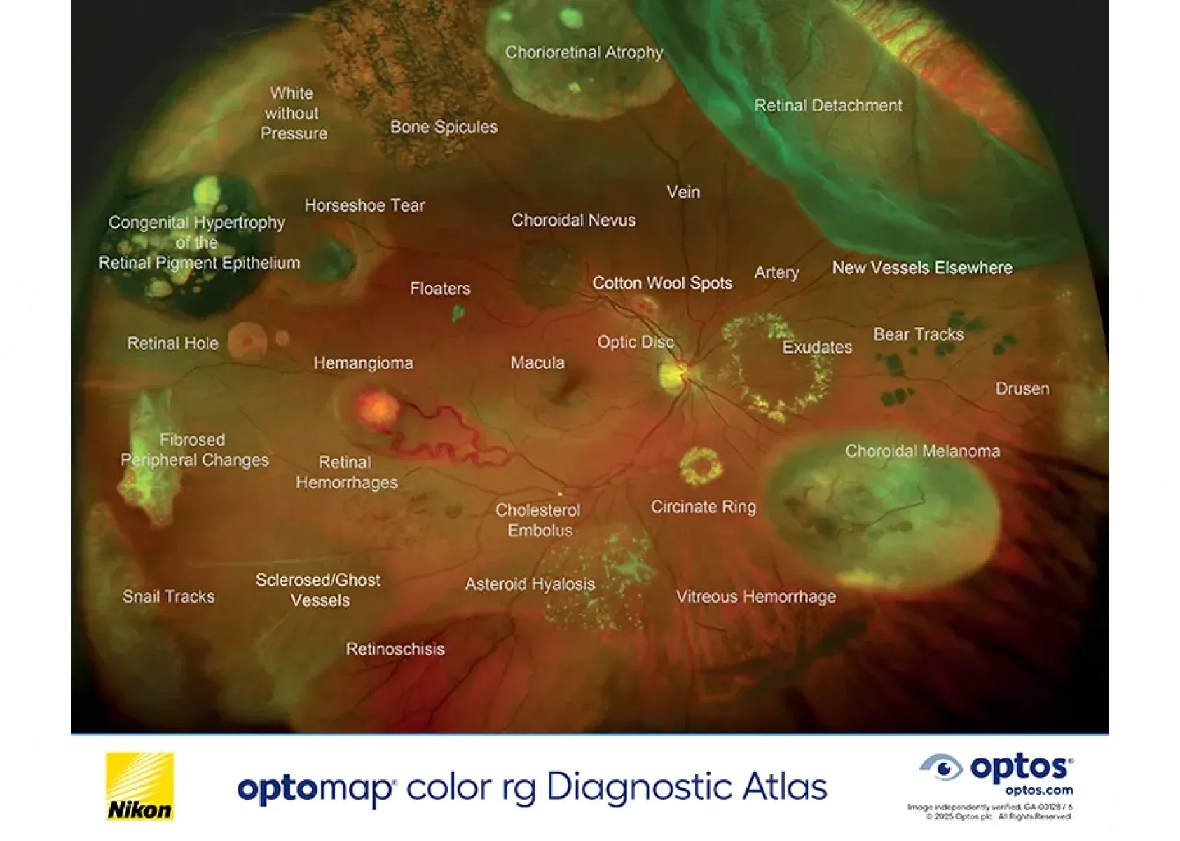 Optomap ultra-widefield retinal image